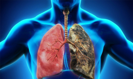 Ai có nguy cơ bị ung thư phổi?